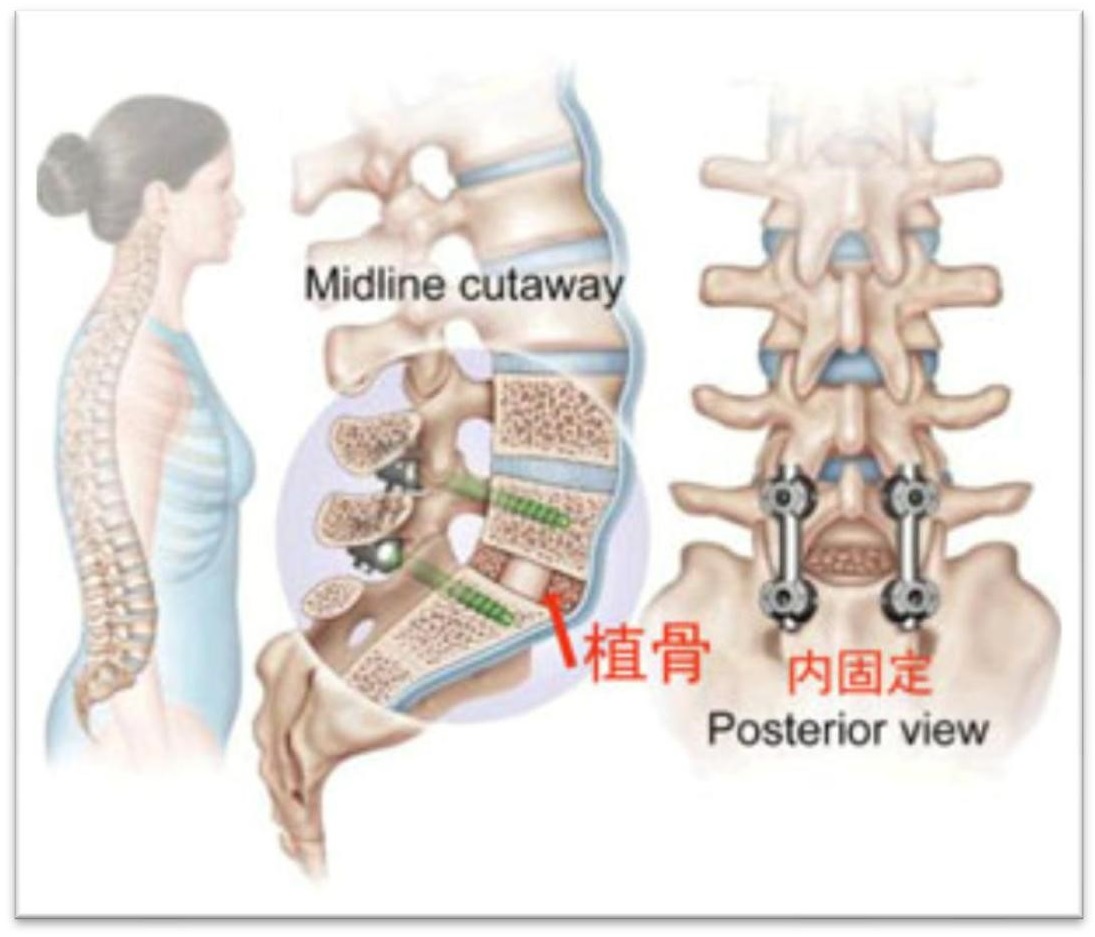 腰椎双侧椎弓根螺钉牢靠三维有限元剖析